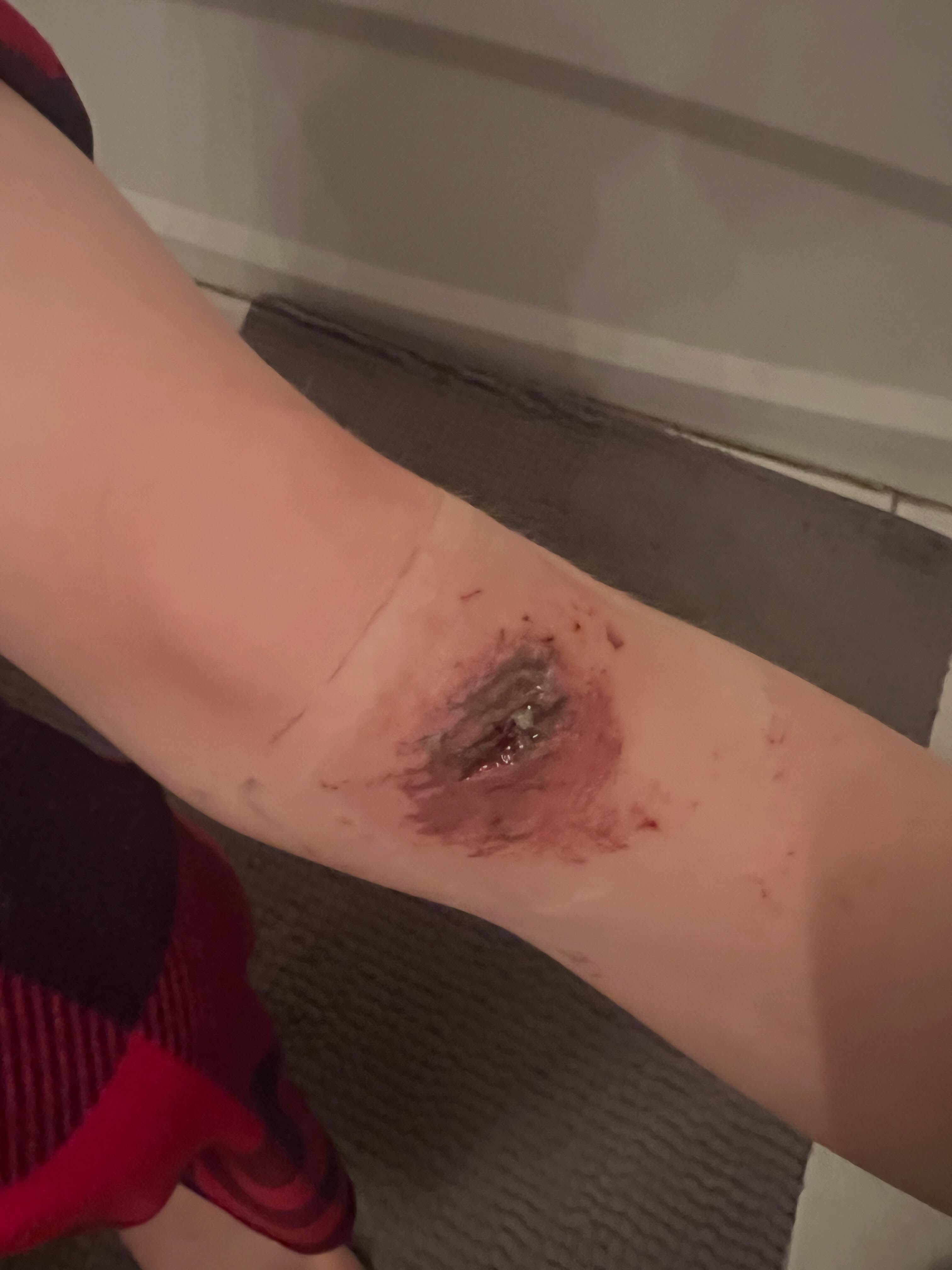 Cycliste à terre ! 🚴‍♂️💥 Mon petit casse-cou a fait une sacrée chute à vélo hier, mais heureusement pour lui, maman est toujours certifiée sauveteure ! 🏅 Les premiers soins ont été parfaits : j’ai nettoyé ses égratignures et les ai soignées avec la crème antibiotique triple action du magasin du mieux-être pour éviter toute infection. Il était de nouveau sur pied (et probablement en train de préparer sa prochaine cascade) en un rien de temps. 😄 Fais attention à toi, mon minou ! ❤️‍🩹

Cyclist down! 🚴‍♂️💥 My little daredevil took quite a tumble off his bike yesterday, but lucky for him, Mom is still a certified lifeguard! 🏅 First aid was on point — cleaned up those scrapes and treated them with Triple Antibiotic cream from the Wellness Store to keep any infections away. He was back on his feet (and probably plotting his next stunt) in no time. 😄 Stay safe out there, my little kitten! ❤️‍🩹 #bikelife #momlife #wellnessstore #firstaid #lifeguardforlife